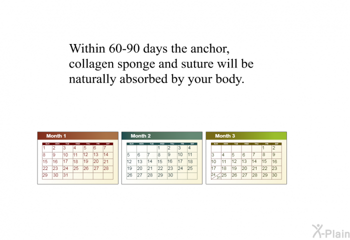 Within 60 to 90 days the anchor, collagen sponge and suture will be naturally absorbed by your body.