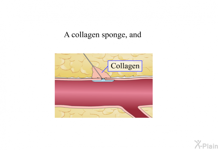 A collagen sponge, and