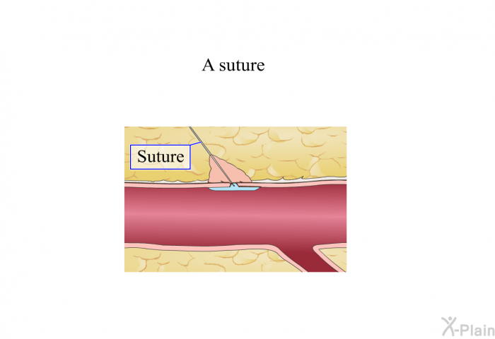 A suture