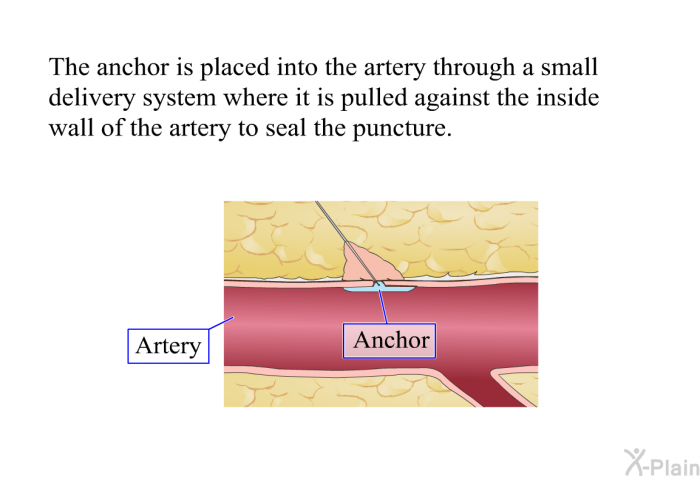 The anchor is placed into the artery through a small delivery system where it is pulled against the inside wall of the artery to seal the puncture.