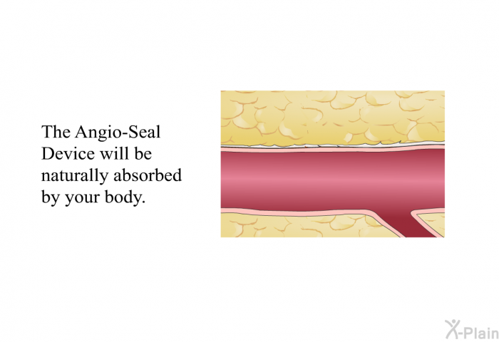 The Angio-Seal Device will be naturally absorbed by your body.