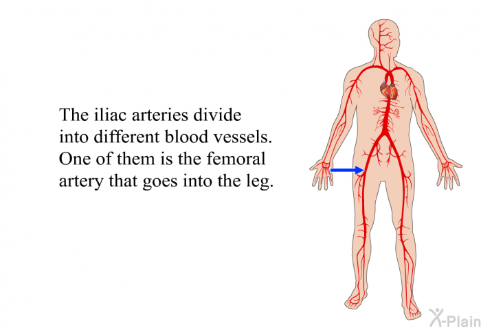 The iliac arteries divide into different blood vessels. One of them is the femoral artery that goes into the leg.