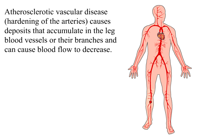 Atherosclerotic vascular disease (hardening of the arteries) causes deposits that accumulate in the leg blood vessels or their branches and can cause blood flow to decrease.