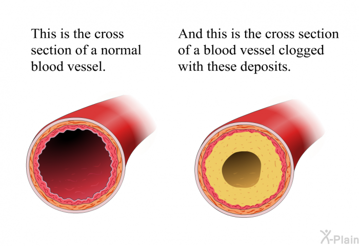 This is the cross section of a normal blood vessel. And this is the cross section of a blood vessel clogged with these deposits.