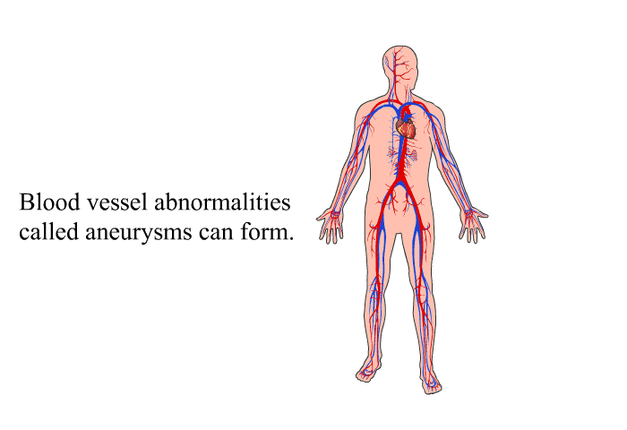 Blood vessel abnormalities called aneurysms can form.