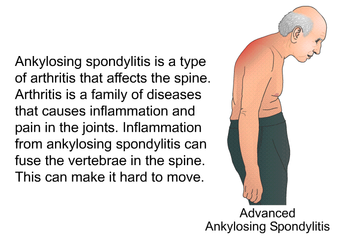 Ankylosing spondylitis is a type of arthritis that affects the spine. Arthritis is a family of diseases that causes inflammation and pain in the joints. Inflammation from ankylosing spondylitis can fuse the vertebrae in the spine. This can make it hard to move.