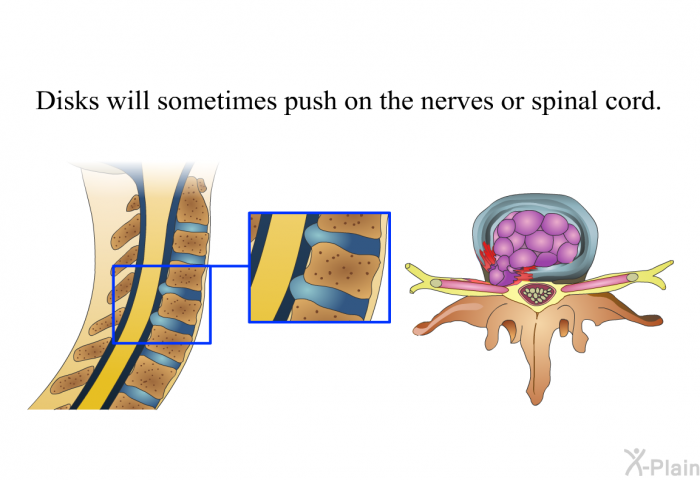 Disks will sometimes push on the nerves or spinal cord.