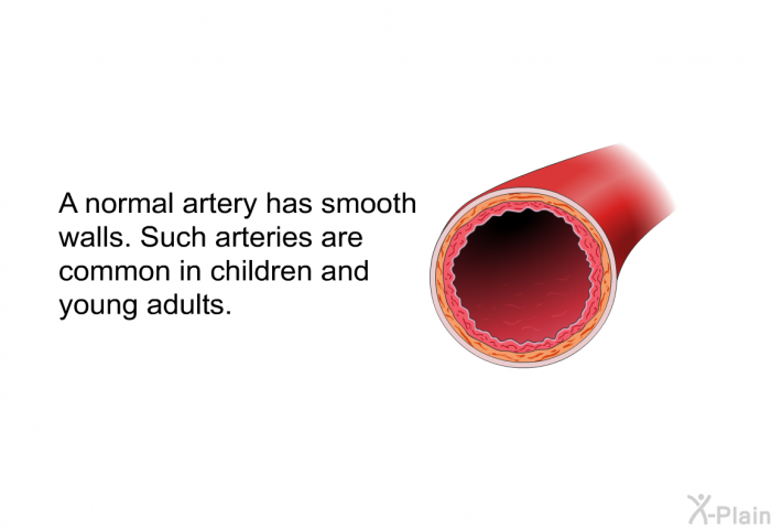 A normal artery has smooth walls. Such arteries are common in children and young adults.