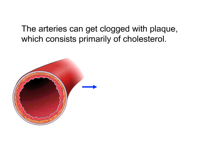The arteries can get clogged with plaque, which consists primarily of cholesterol.
