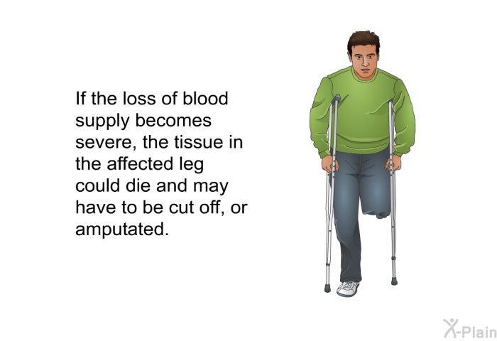 If the loss of blood supply becomes severe, the tissue in the affected leg could die and may have to be cut off, or amputated.