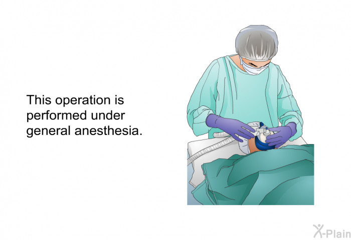 This operation is performed under general anesthesia.