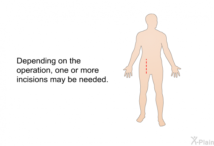 Depending on the operation, one or more incisions may be needed.