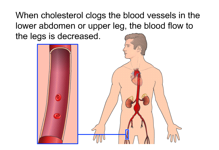 When cholesterol clogs the blood vessels in the lower abdomen or upper leg, the blood flow to the legs is decreased.