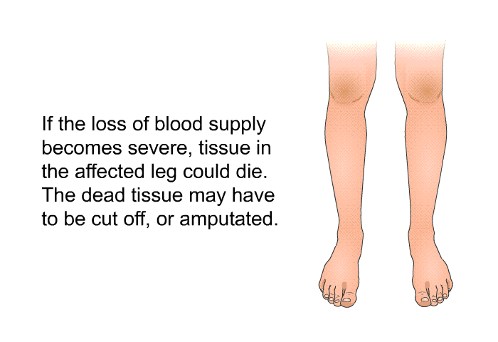 If the loss of blood supply becomes severe, tissue in the affected leg could die. The dead tissue may have to be cut off, or amputated.