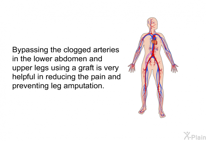 Bypassing the clogged arteries in the lower abdomen and upper legs using a graft is very helpful in reducing the pain and preventing leg amputation.