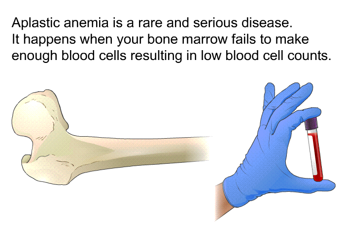 Aplastic anemia is a rare and serious disease. It happens when your bone marrow fails to make enough blood cells resulting in low blood cell counts.