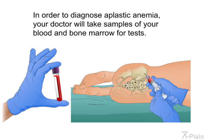 In order to diagnose aplastic anemia, your doctor will take samples of your blood and bone marrow for tests.
