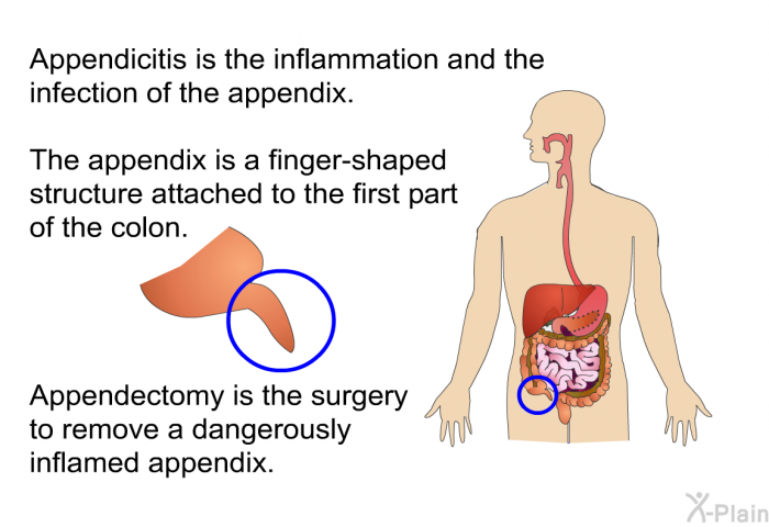 Appendicitis is the inflammation and the infection of the appendix. The appendix is a finger-shaped structure attached to the first part of the colon. Appendectomy is the surgery to remove a dangerously inflamed appendix.