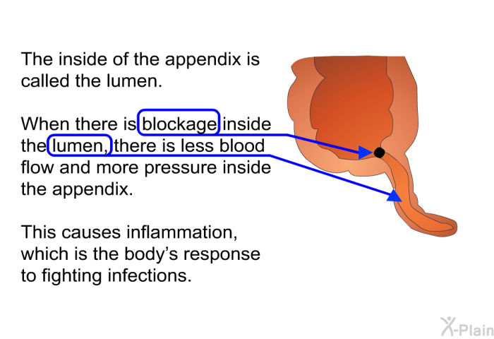 The inside of the appendix is called the lumen. When there is blockage inside the lumen, there is less blood flow and more pressure inside the appendix. This causes inflammation, which is the body's response to fighting infections.