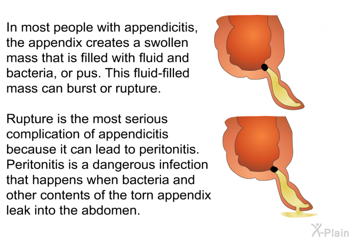 In most people with appendicitis, the appendix creates a swollen mass that is filled with fluid and bacteria, or pus. This fluid-filled mass can burst or rupture. Rupture is the most serious complication of appendicitis because it can lead to peritonitis. Peritonitis is a dangerous infection that happens when bacteria and other contents of the torn appendix leak into the abdomen.