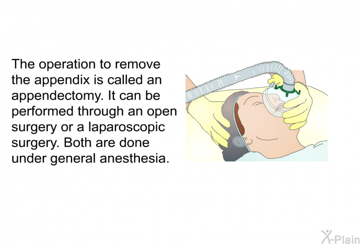 The operation to remove the appendix is called an appendectomy. It can be performed through an open surgery or a laparoscopic surgery. Both are done under general anesthesia.