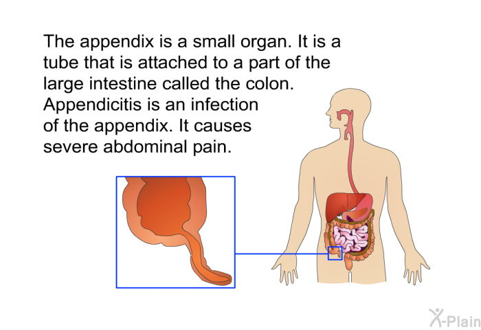 The appendix is a small organ. It is a tube that is attached to a part of the large intestine called the colon. Appendicitis is an infection of the appendix. It causes severe abdominal pain.