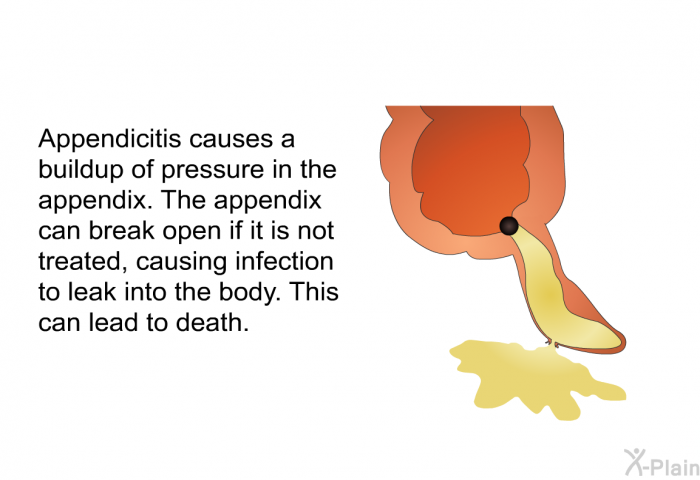 Appendicitis causes a buildup of pressure in the appendix. The appendix can break open if it is not treated, causing infection to leak into the body. This can lead to death.