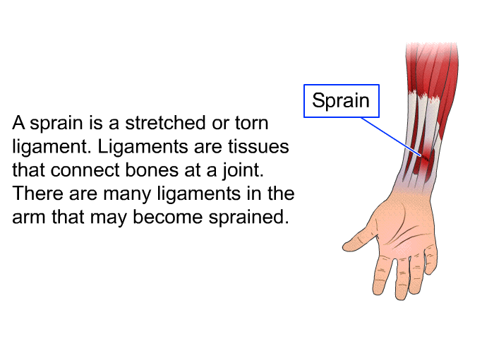 A sprain is a stretched or torn ligament. Ligaments are tissues that connect bones at a joint. There are many ligaments in the arm that may become sprained.