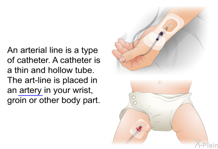 An arterial line is a type of catheter. A catheter is a thin and hollow tube. The art-line is placed in an artery in your wrist, groin or other body part.