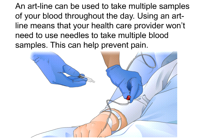 An art-line can be used to take multiple samples of your blood throughout the day. Using an art-line means that your health care provider won't need to use needles to take multiple blood samples. This can help prevent pain.