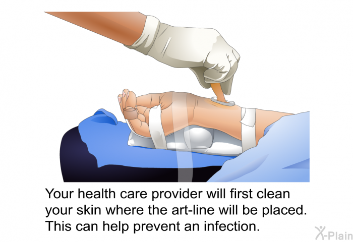 Your health care provider will first clean your skin where the art-line will be placed. This can help prevent an infection.
