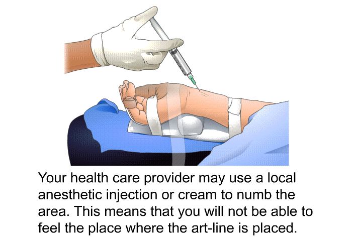 Your health care provider may use a local anesthetic injection or cream to numb the area. This means that you will not be able to feel the place where the art-line is placed.
