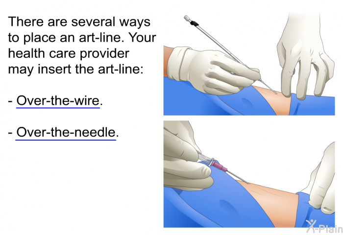There are several ways to place an art-line. Your health care provider may insert the art-line:  Over-the-wire. Over-the-needle.