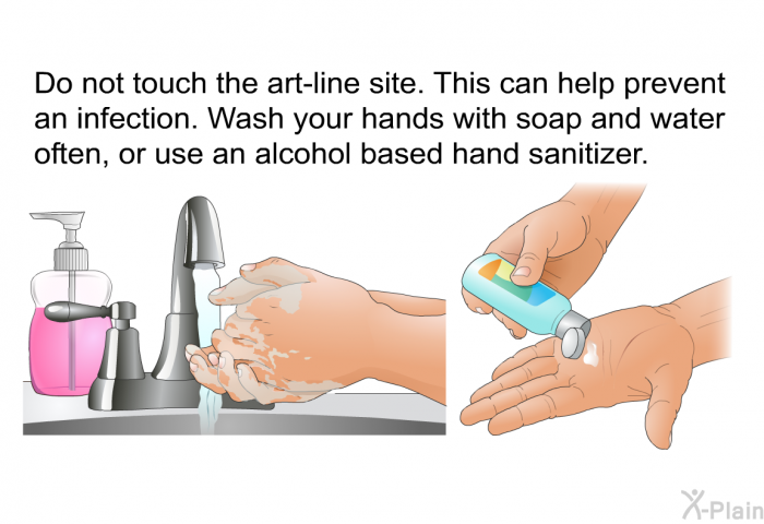 Do not touch the art-line site. This can help prevent an infection. Wash your hands with soap and water often, or use an alcohol based hand sanitizer.