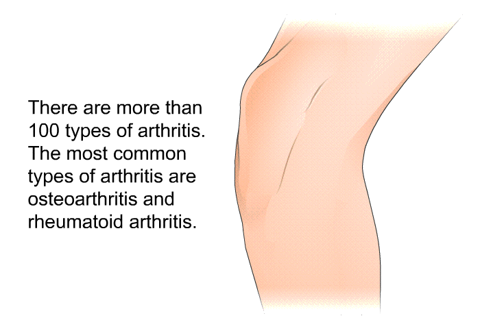 There are more than 100 types of arthritis. The most common types of arthritis are osteoarthritis and rheumatoid arthritis.
