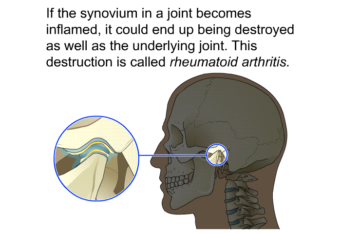 If the synovium in a joint becomes inflamed, it could end up being destroyed as well as the underlying joint. This destruction is called <I>rheumatoid arthritis</I>.