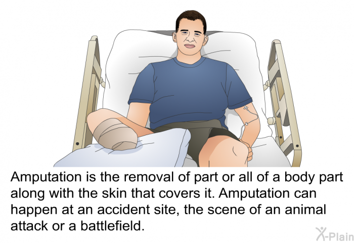 Amputation is the removal of part or all of a body part along with the skin that covers it. Amputation can happen at an accident site, the scene of an animal attack or a battlefield.