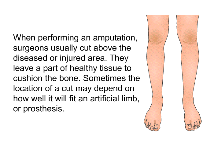 When performing an amputation, surgeons usually cut above the diseased or injured area. They leave a part of healthy tissue to cushion the bone. Sometimes the location of a cut may depend on how well it will fit an artificial limb, or prosthesis.