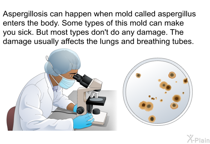 Aspergillosis can happen when mold called aspergillus enters the body. Some types of this mold can make you sick. But most types don't do any damage. The damage usually affects the lungs and breathing tubes.