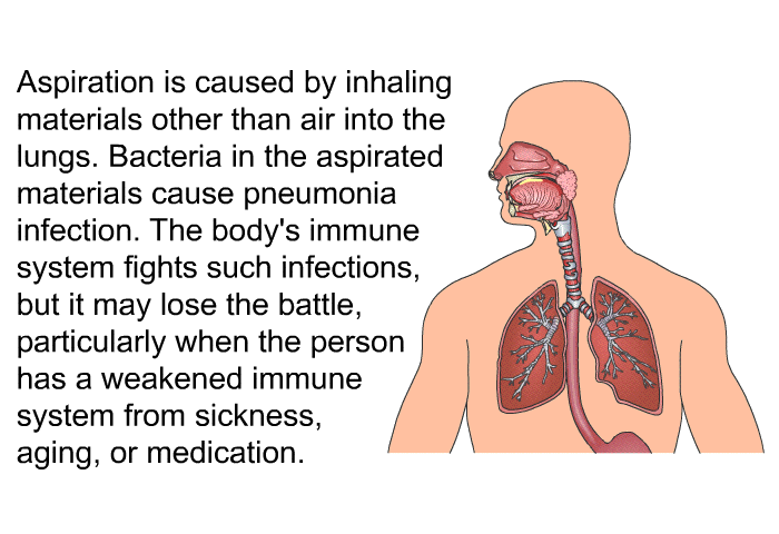 PatEdu Aspiration Pneumonia