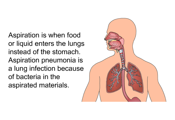 Aspiration is when food or liquid enters the lungs instead of the stomach. Aspiration pneumonia is a lung infection because of bacteria in the aspirated materials.
