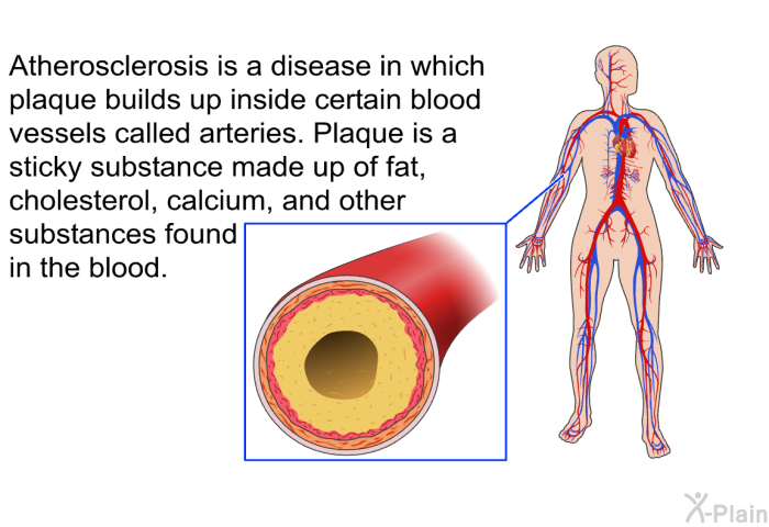 Atherosclerosis is a disease in which plaque builds up inside certain blood vessels called arteries. Plaque is a sticky substance made up of fat, cholesterol, calcium, and other substances found in the blood.