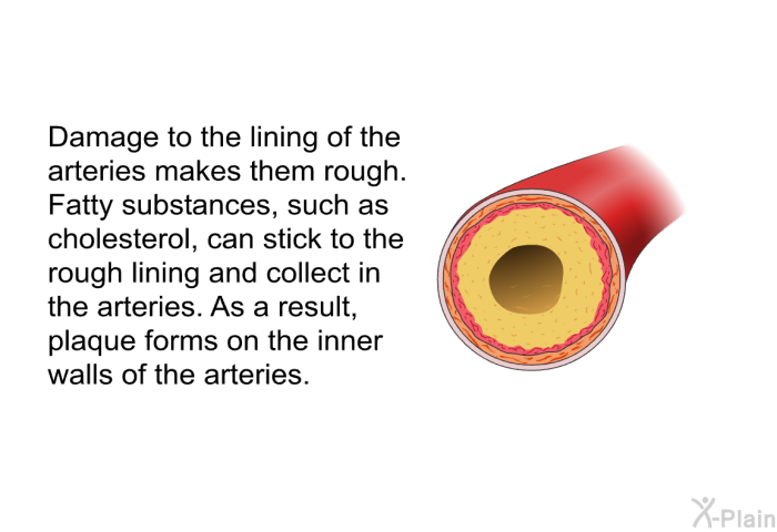 Damage to the lining of the arteries makes them rough. Fatty substances, such as cholesterol, can stick to the rough lining and collect in the arteries. As a result, plaque forms on the inner walls of the arteries.