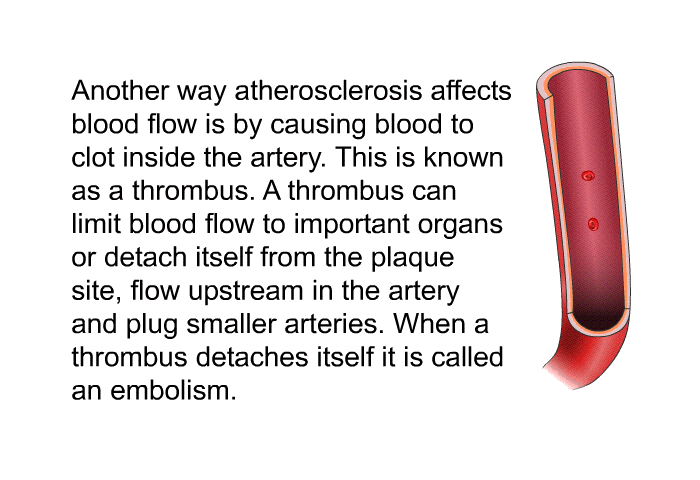 Another way atherosclerosis affects blood flow is by causing blood to clot inside the artery. This is known as a thrombus. A thrombus can limit blood flow to important organs or detach itself from the plaque site, flow upstream in the artery and plug smaller arteries. When a thrombus detaches itself it is called an embolism.