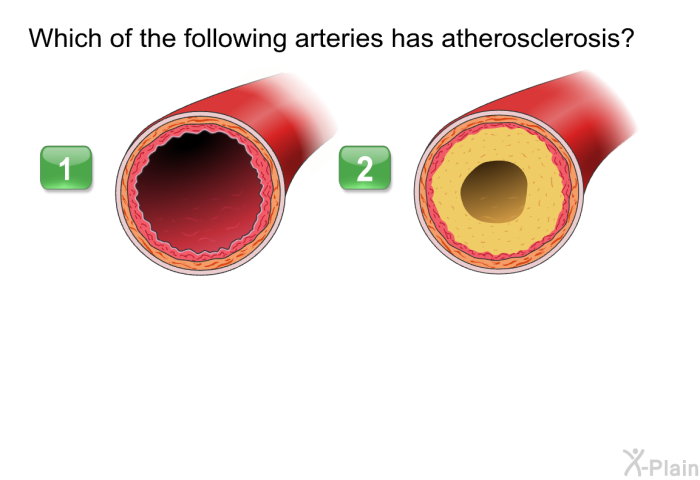 Which of the following arteries has atherosclerosis?