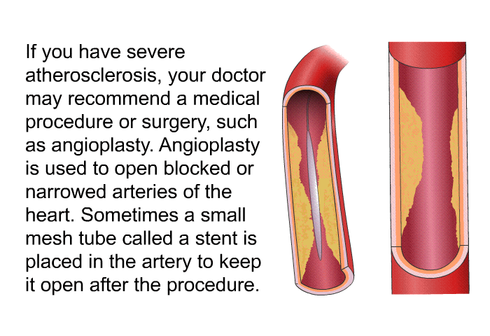 If you have severe atherosclerosis, your doctor may recommend a medical procedure or surgery, such as angioplasty. Angioplasty is used to open blocked or narrowed arteries of the heart. Sometimes a small mesh tube called a stent is placed in the artery to keep it open after the procedure.