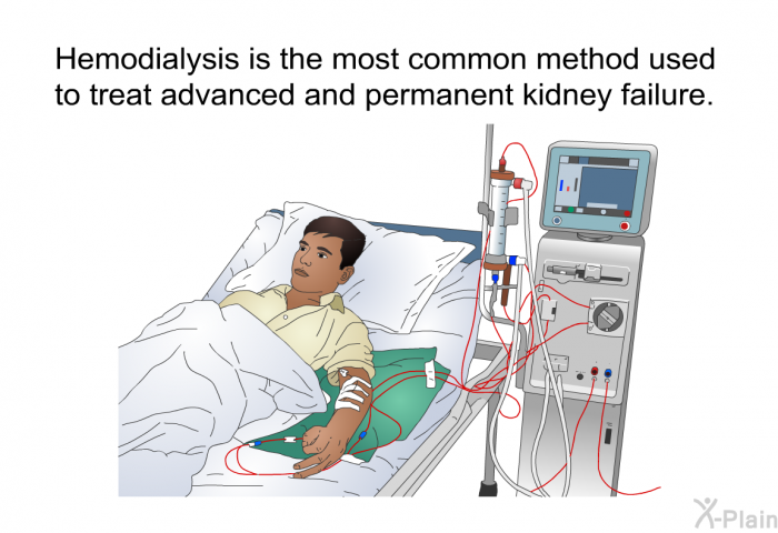 Hemodialysis is the most common method used to treat advanced and permanent kidney failure.