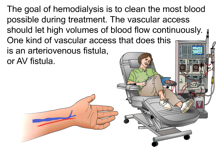 The goal of hemodialysis is to clean the most blood possible during treatment. The vascular access should let high volumes of blood flow continuously. One kind of vascular access that does this is an arteriovenous fistula, or AV fistula.