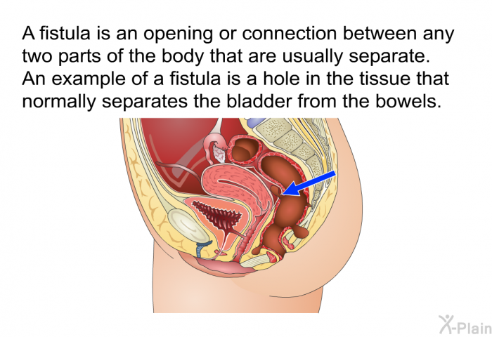 A fistula is an opening or connection between any two parts of the body that are usually separate. An example of a fistula is a hole in the tissue that normally separates the bladder from the bowels.