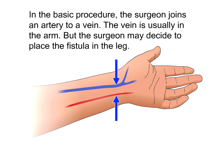 In the basic procedure, the surgeon joins an artery to a vein. The vein is usually in the arm. But the surgeon may decide to place the fistula in the leg.
